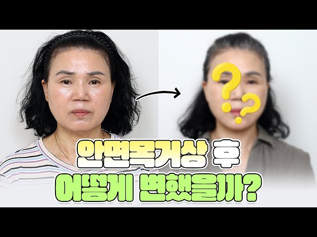 50대 후반 여자 안면거상, 팔자 심부볼 처짐과 인상까지 한 번에 개선🥰