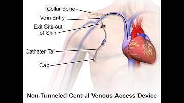 Central venous catheter CPT code - simplify medical coding