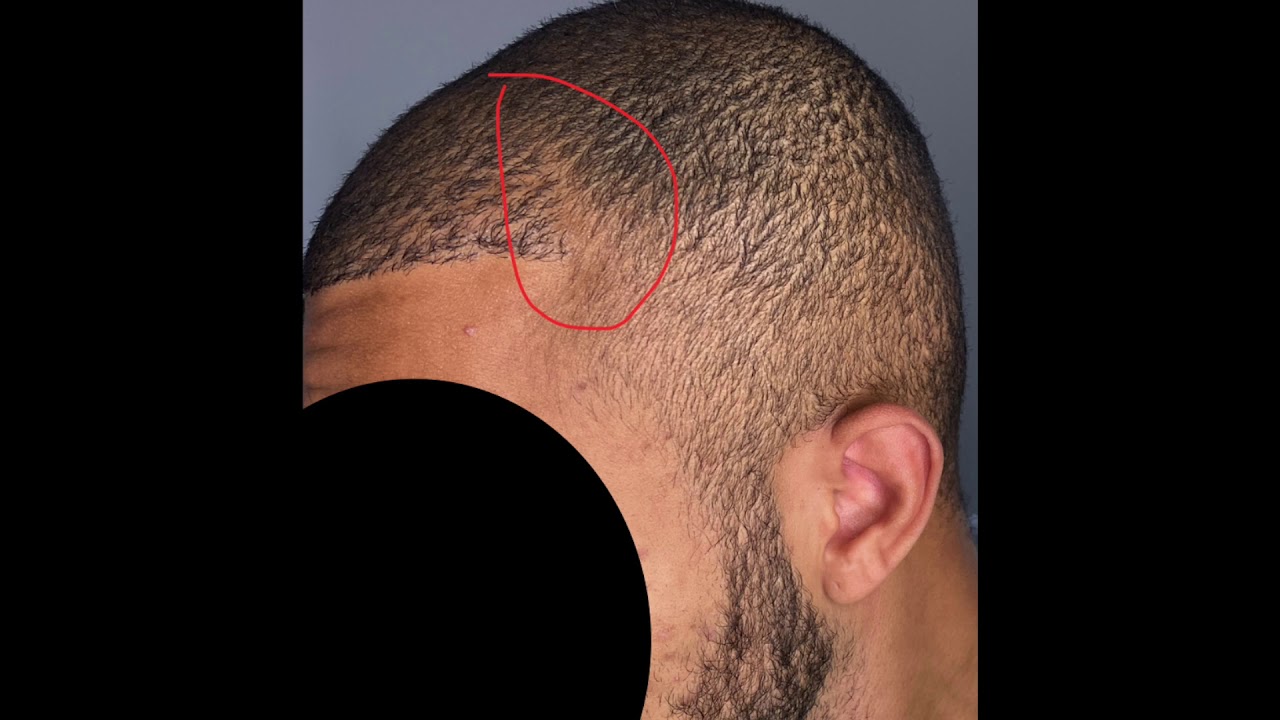 Month 11 Black Hair Transplant In Turkey YouTube