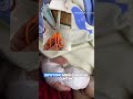 RS di Thailand Minta Maaf Setelah Perawat Tidak Sengaja Gunting Jari Balita #shorts