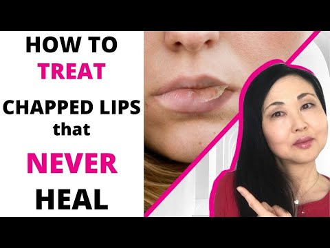 How to TREAT Chapped Lips that never heal  (Actinic Cheilitis-4 GRADES)