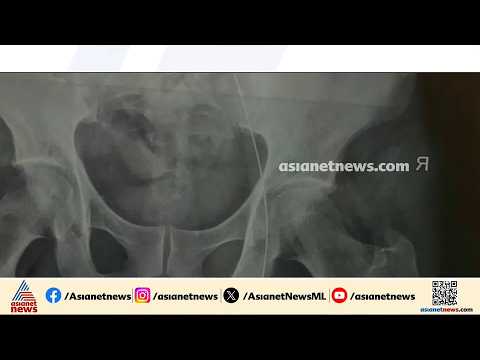 ശസ്ത്രക്രിയ ചെയ്ത രോഗിയുടെ ശരീരത്തിൽ ഗൈഡ് വയര്‍ മറന്നുവെച്ചു; ഡോക്ടര്‍ക്കെതിരെ പരാതി