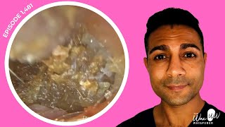 1,482 - Routine Ear Wax Removal Unearths Canal Epithelial Hyperplasia
