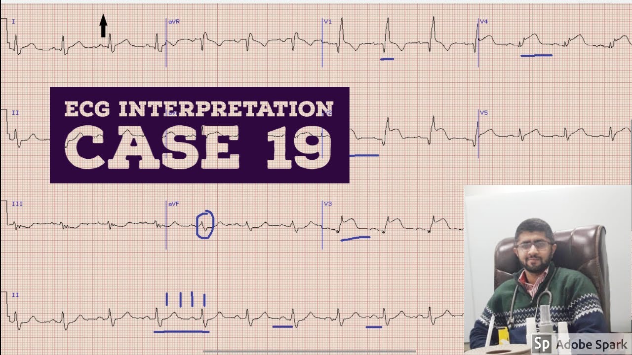 ECG INTERPRETATION CASE 19 |EKG| ELECTROCARDIOGRAM| EDUCATIONAL VIDEO ...