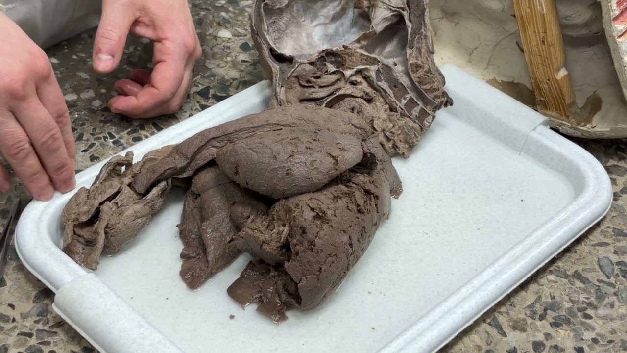 Lungs, pleura, Mediastinum. (04/04/2026)