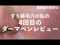 【すり鉢毛穴】4回目のダーマペンを受けてきました！私が行ったクリニック紹介/金額/施術/肌の経過/効果について（毛穴/開き毛穴/いちご鼻/ニキビ跡/角栓/黒ずみ/ニキビ肌）