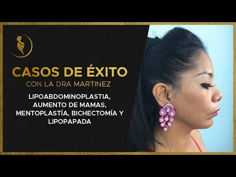 Lipoescultura y Abdominoplastia de Magaly Salgado