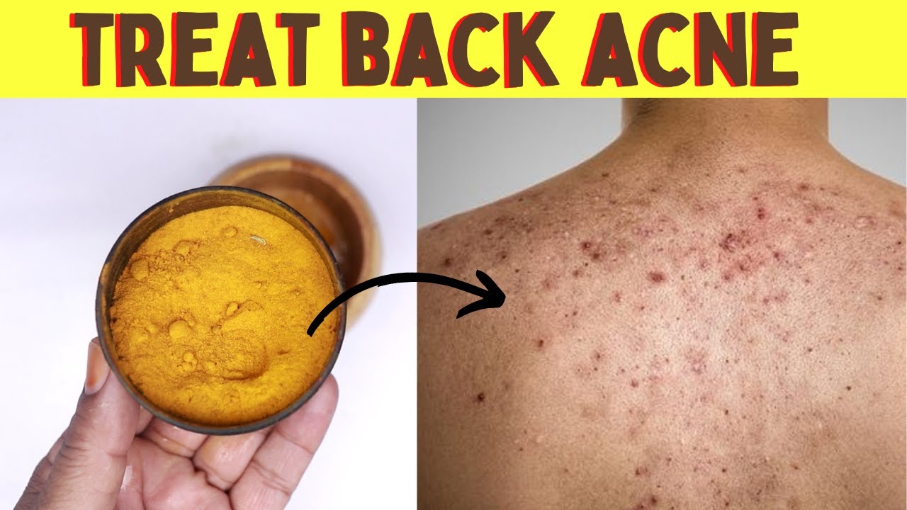 How To Get Rid Of Back Acne On Back And Shoulders Overnight In A Week