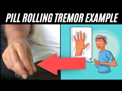 Video: Pill Rolling Tremor: Parkinson, Motion Og Mer