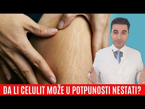 Video: Celulit na bedrima: uzroci, načini da se riješite, savjeti o prehrani