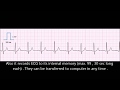 Mobile electrocardiograph BEURER ME80, ME90  . How to record High Quality ECG with it