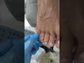 Ortesis de silicona-Dr.Franklin vargas- podologo