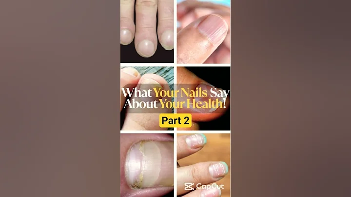 "Nail Health Red Flags You Shouldn't Ignore"(PART 2) #nailhealth#brittle #healthtips#wellness#shorts