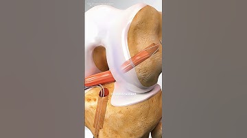 How ACL Surgery Is Performed (3D animation) #music #motivation #epic #ilimb