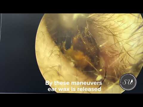 Endoscopic ear wax removal impacted cerumen removal bodrum kulak kiri temizliği yıkanması kliniği