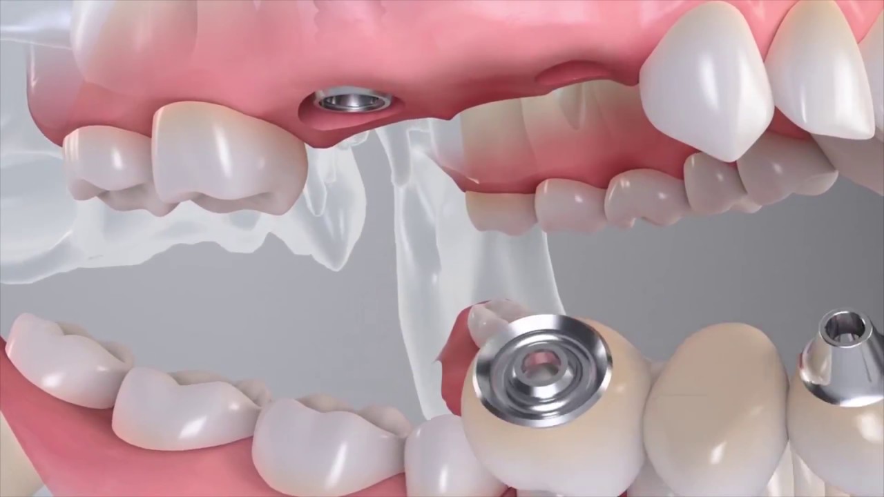 Ocean Dental Cancun | Dental Bridges Mexico: How is the procedure?