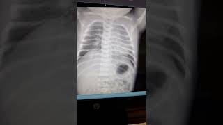 Plethoric lung 🫁 ( shunt, fluid overload) 
