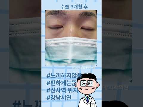 남자 가성안검하수 전후 변화 | 느끼하지 않고 담백한 인상