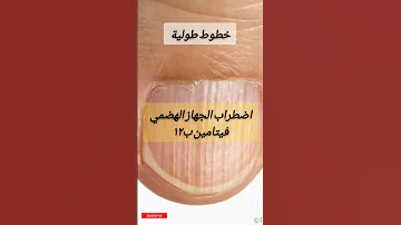 الأظافر و علامات نقص الفيتامينات و المعادن 