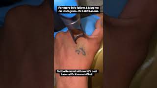 World’s best laser for Tattoo Removal Treatment at Dr  Kasana’s Clinic