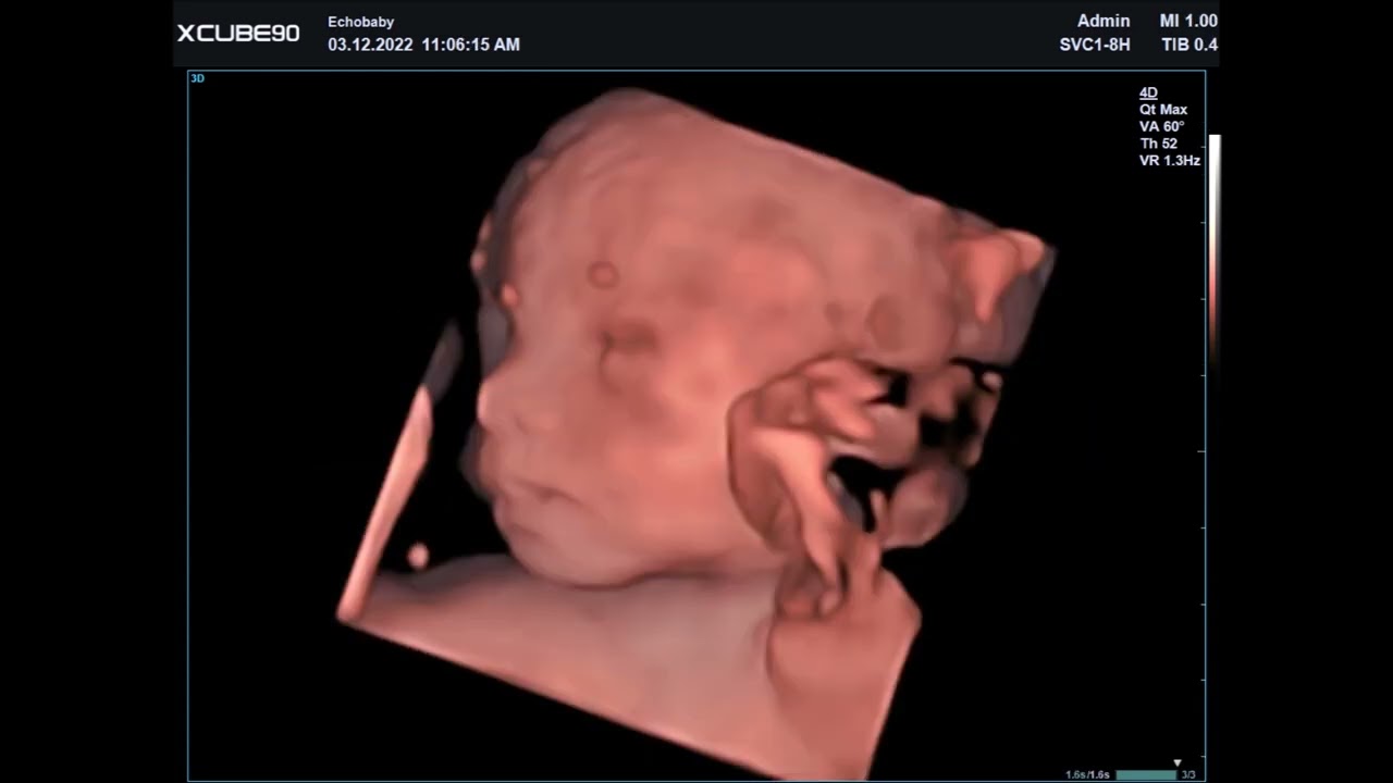 3D  Pretecho 23 Weken Zwanger