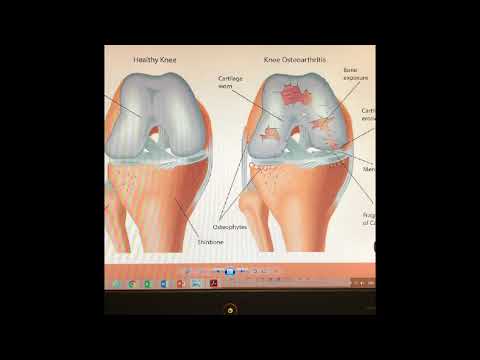 علاج الجلوكوزامين والكونتدروتين للركب