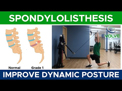 Spondylolisthesis | Exercises