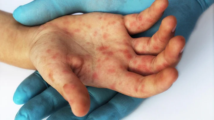 Health alert: New York, New Jersey officials warn of potential measles exposure