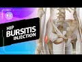 How steroids can treat hip bursitis (3D Animation)