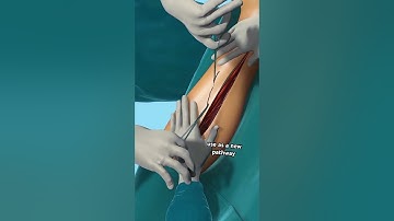 Heart Bypass Surgery!! (3D Animation) #drone #theflash #space #automobile #scifi #spacefighter