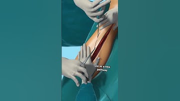 Heart Bypass Surgery!! (3D Animation) #drone #theflash #space #automobile #scifi #spacefighter