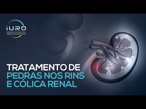 Vídeo: Litoterapia - Tratamento Com Cálculos