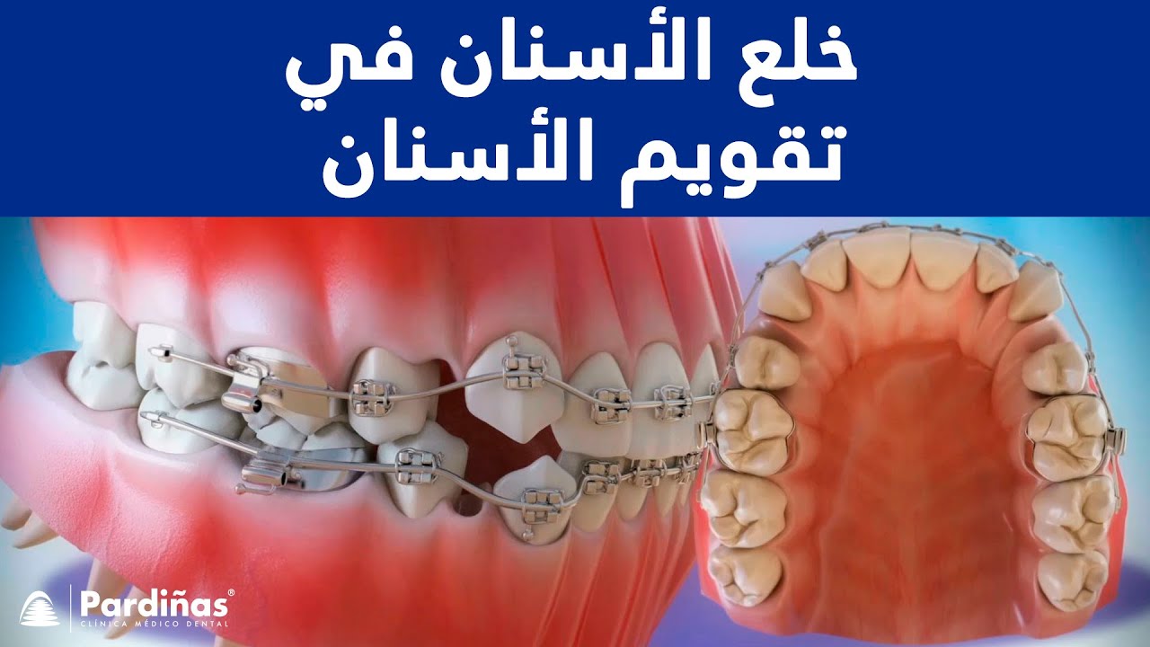 كيف تتم زراعة الاسنان ؟ - Dental Implant