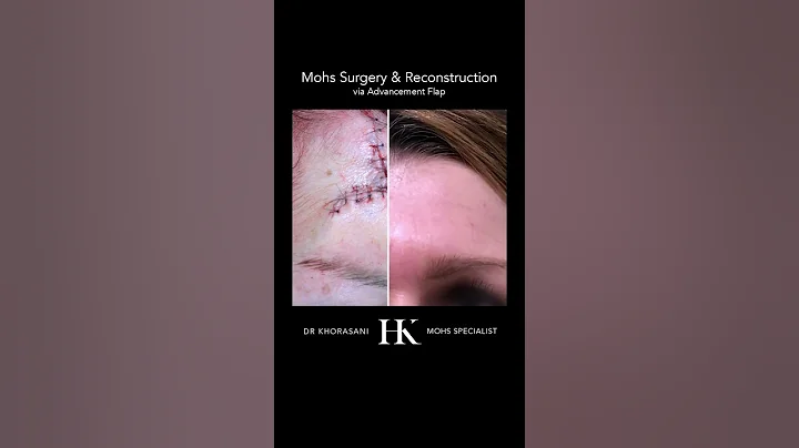 Scar Revision on Forehead after Mohs Surgery via Advancement Flap closure | Dr. Hooman Khorasani