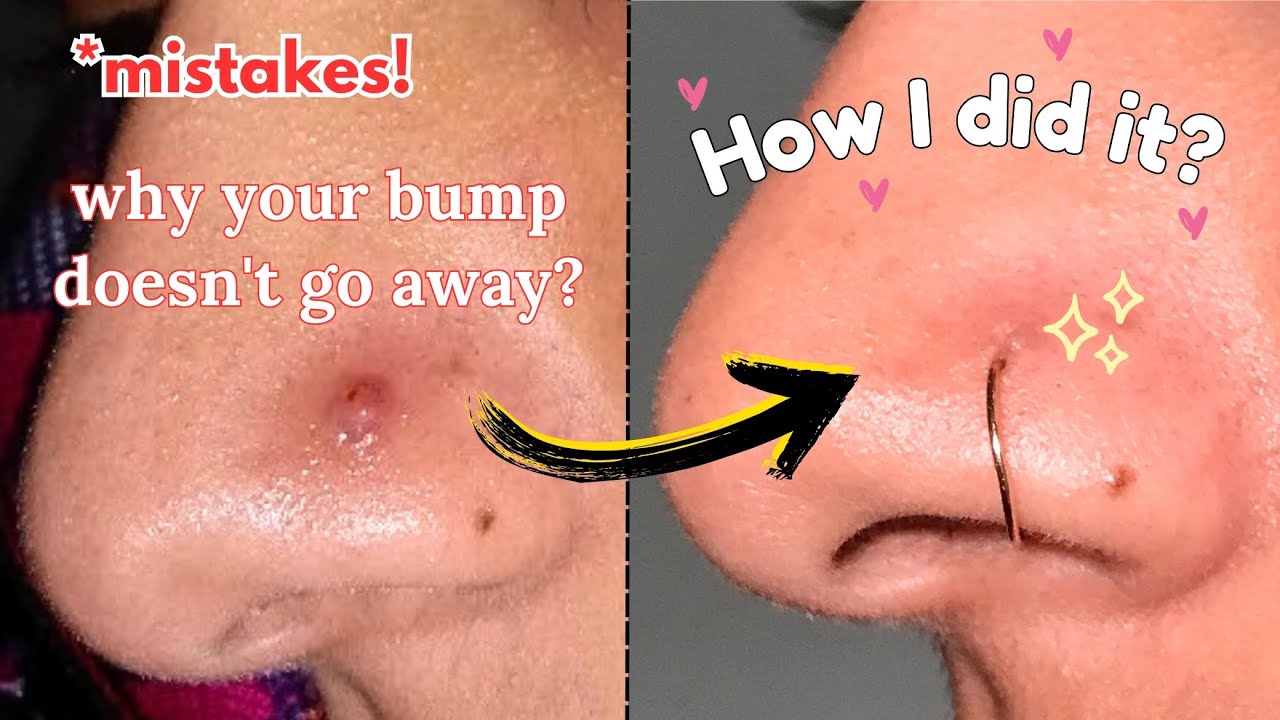 Nose Piercing Bump Removal in right way!
