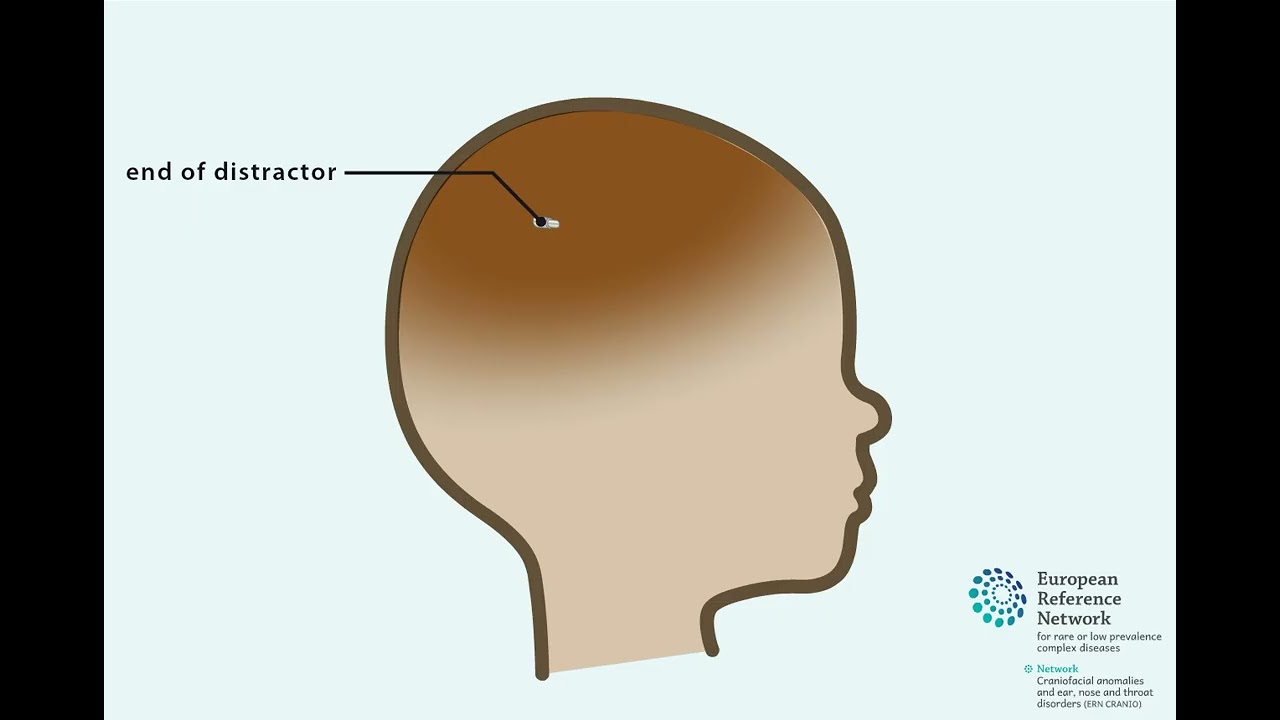 Correctie van het voorhoofd bij plagiocefalie
