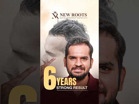Hair Transplant in Hyderabad | Cost and Best Results | Telugu #hairtransplant #telugu #shorts