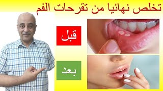 علاج قرحة الفم