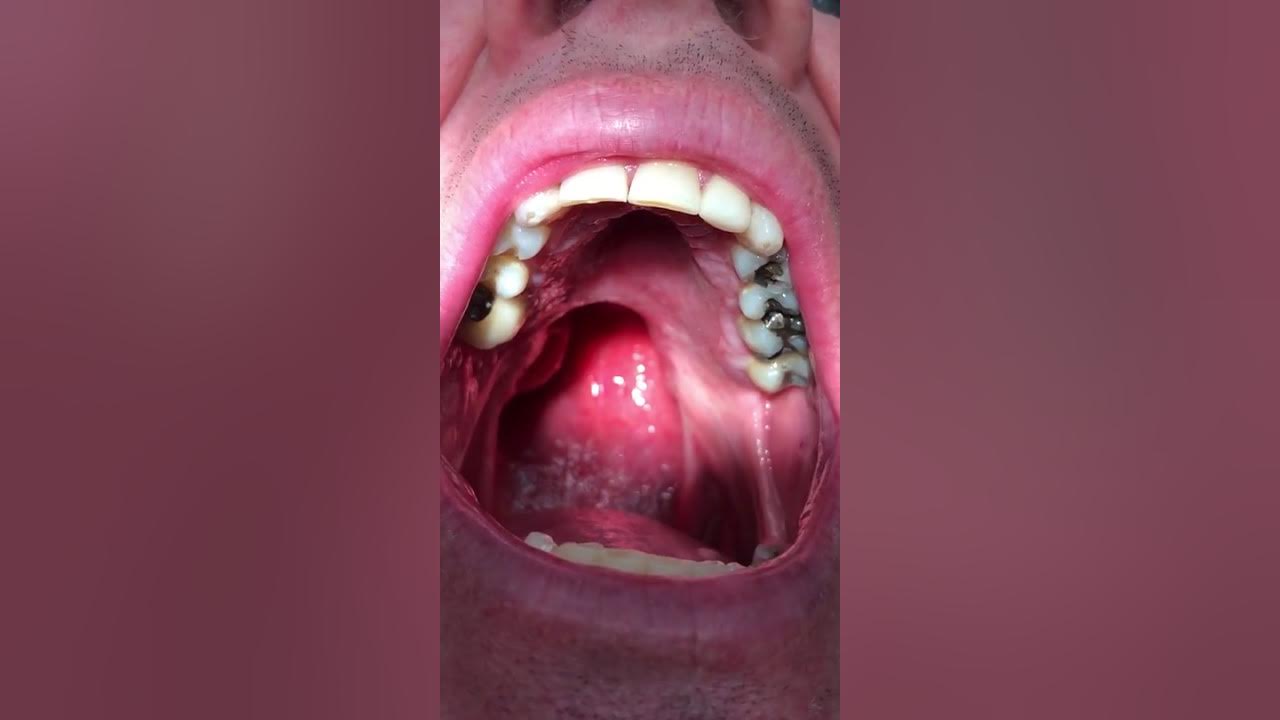 Large Ulcer On Soft Palate