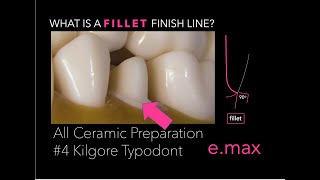 All Ceramic Crown Preparation for Lithium Disilicate #4 KILGORE