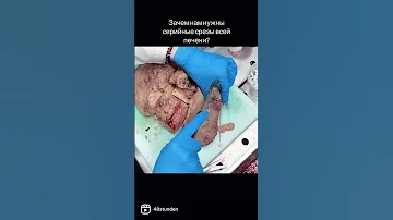 Цирроз печени, вырезка