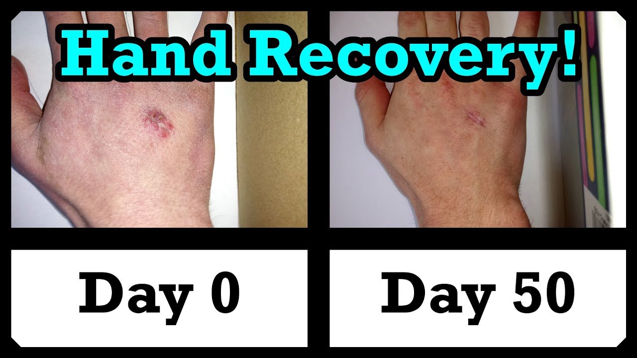 My Hand Injury 50 Day Healing Time-lapse!) - YouTube