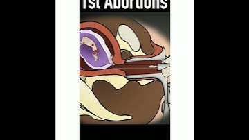 3D animation of abortion|| abortion kaise hota hai🤰