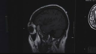 Sexual Assault brain damage research Wealth