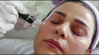 microneedling for skin rejuvenation