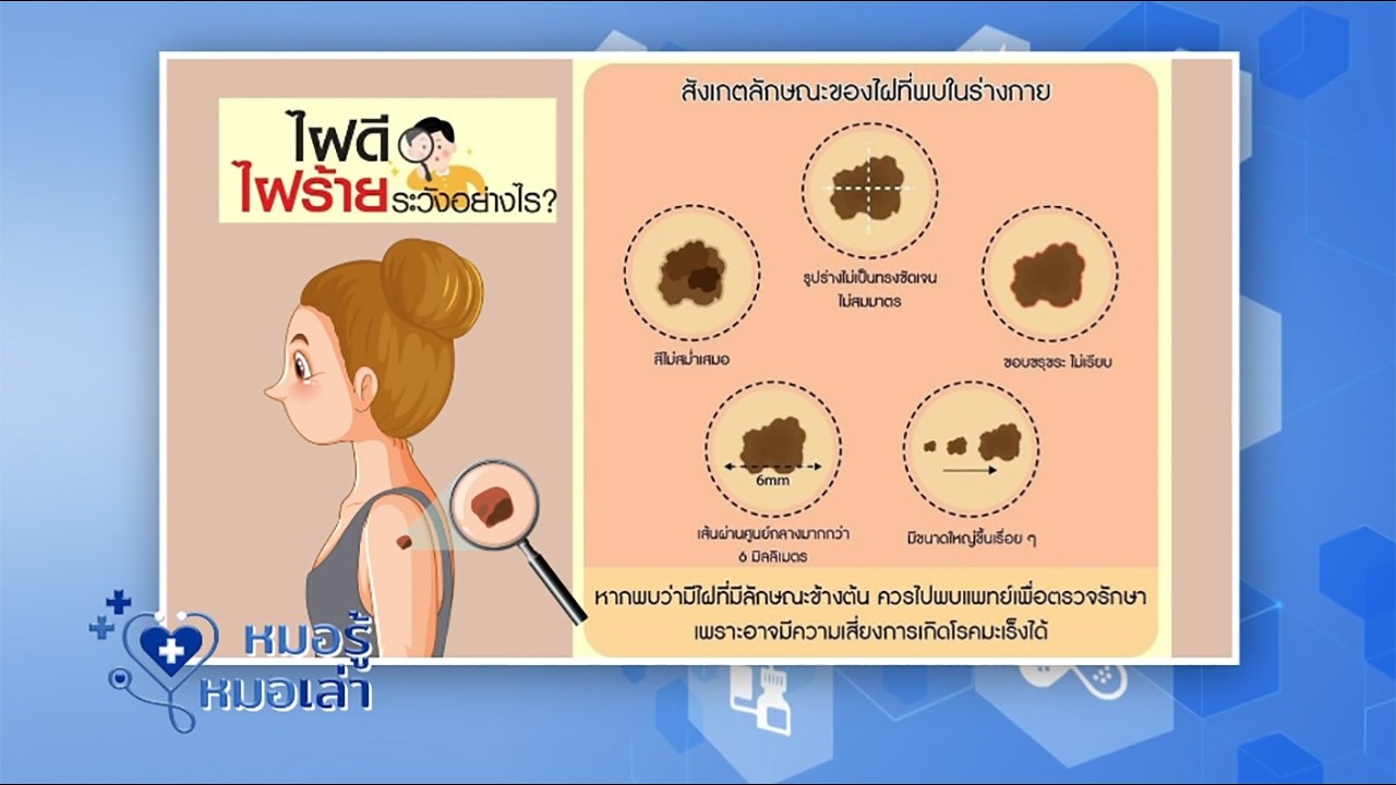 “ หมอรู้ หมอเล่า ” EP.33 : ไฝ หรือ มะเร็งเม็ดสี แตกต่างกันอย่างไร