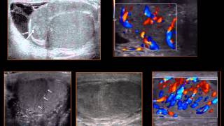 Scrotal Ultrasound