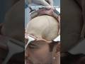 How a craniotomy is performed -3D ANIMATION