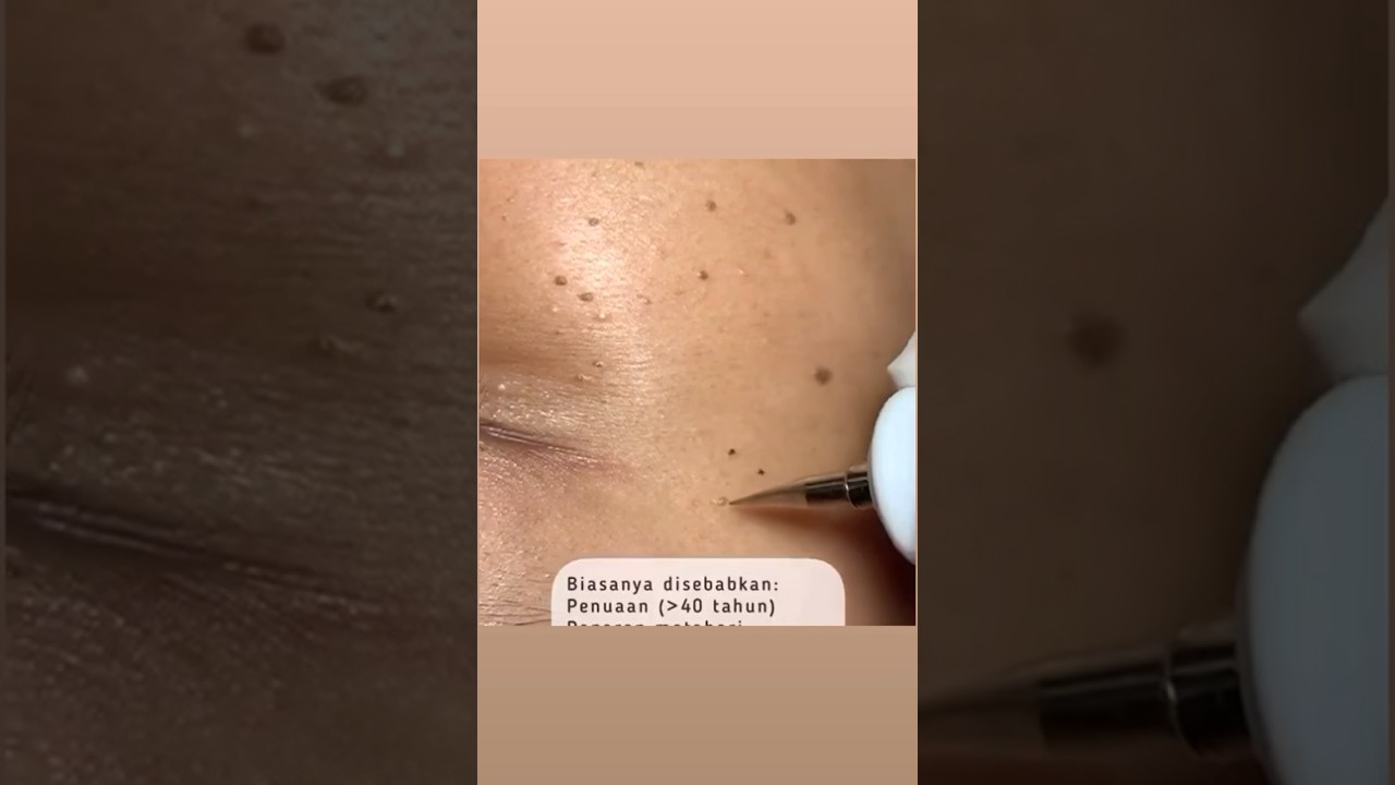 Cara menghilangkan flek kecil kecil di wajah cara menghilanhkan flek membandel cara laser darkspot