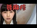蕁麻疹が痒すぎた